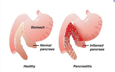  Pancreas homeopathy treatment clinic in chennai