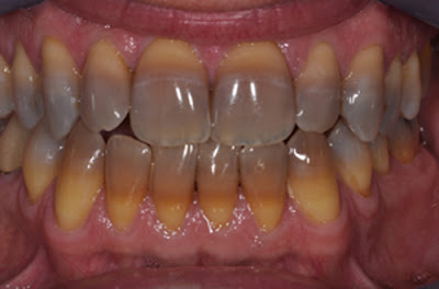 Khắc phục răng nhiễm màu tetracyclin hiệu quả 1