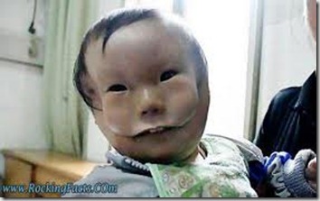 Chinese baby born with mask face 1 Chinese baby born with mask face 1