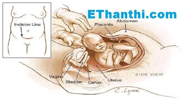 சிசேரியன் தேவை தானா?
