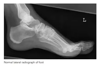plantar fasciitis x ray