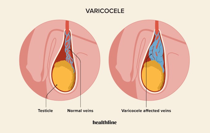 Varicocele: Understanding, Prevention, and Treatment