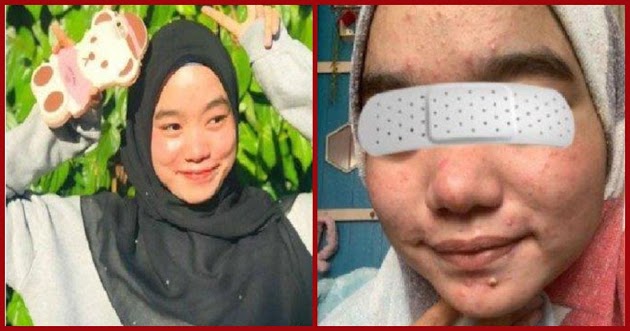 Viral Curhat Gadis Cantik 2 Minggu Pakai Krim Langsung Glowing, Kini Menyesal Kulit Wajah Rusak