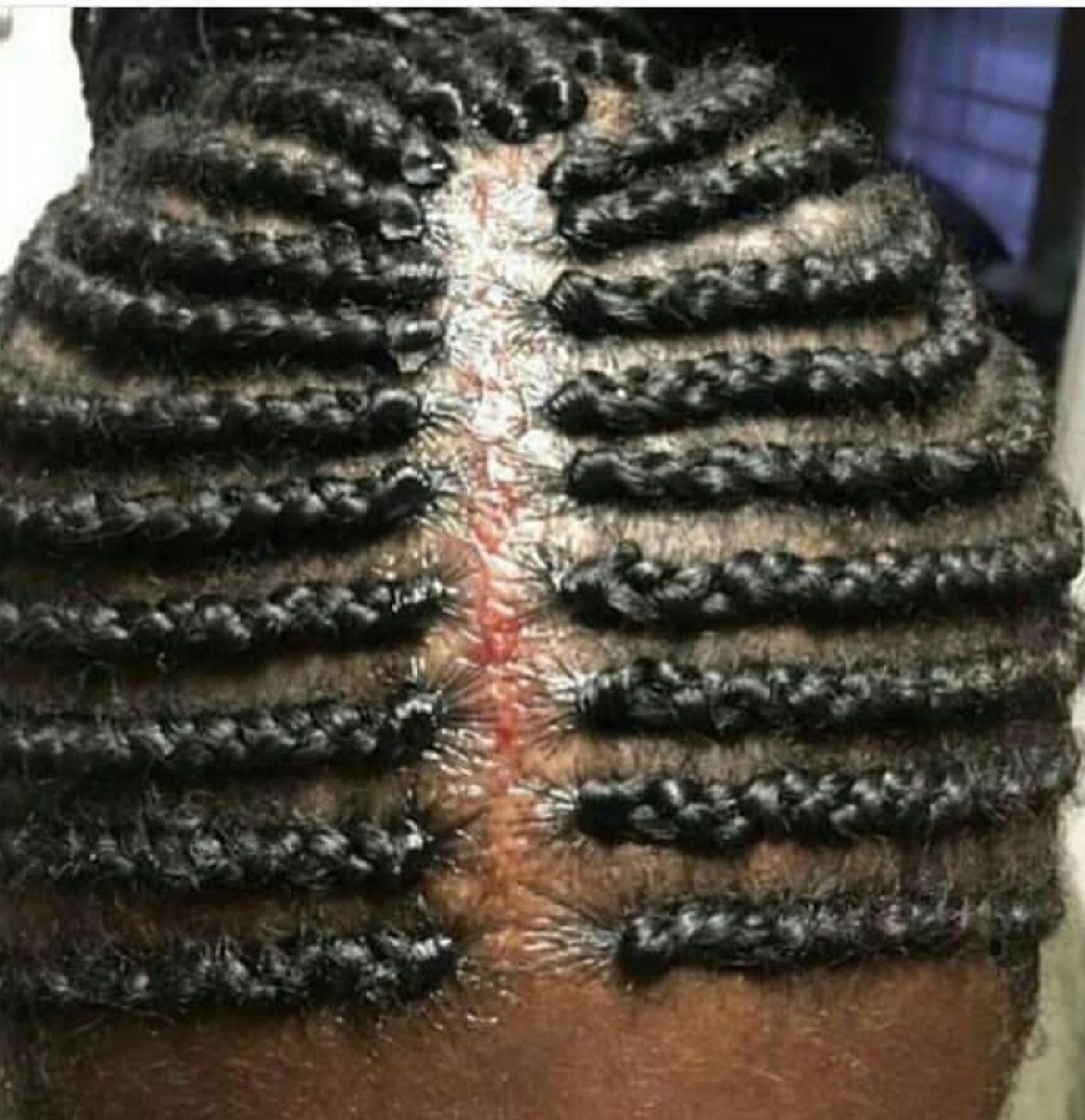 Internet Shocked Over Bloody Scalp And Braids Photo