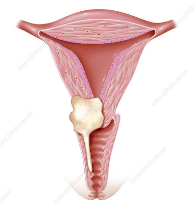 Gynecological Cancer Drugs