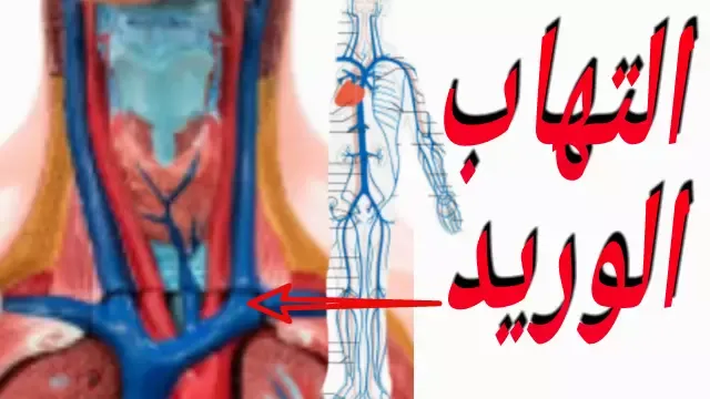 اسباب التهاب الوريد