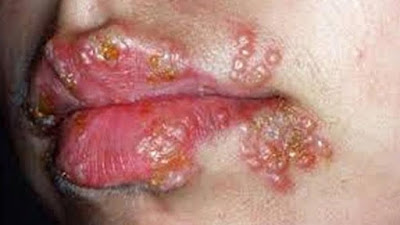 Herpes Pada Bibir