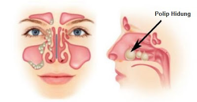 Cara Mengobati Polip Hidung