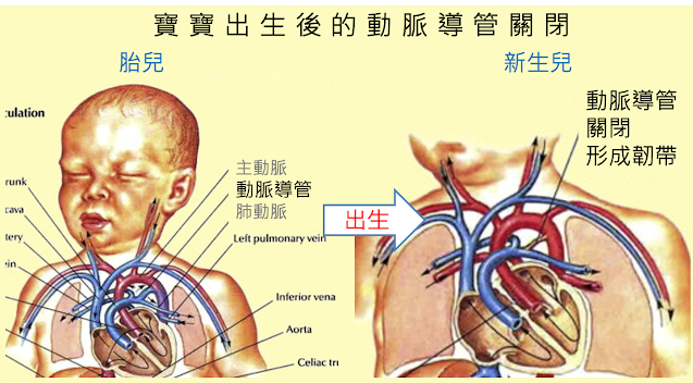 動脈導管關閉