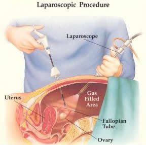 Jenis dan Fungsi Alat-alat Kedokteran - Laparoscopy