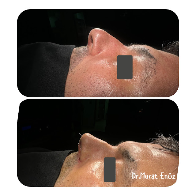 Caudal Septoplasty - Open Technique Septoplasty