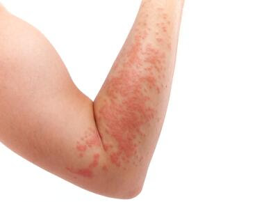 What is Eczema 
