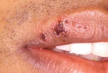 Resultado de imagem para DICAS TERAPÊUTICAS - Como Tratar Cobreiro (Herpes Zoster)