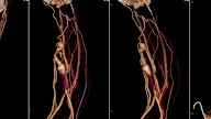 AV Hemodialysis Shunt Thrombosis