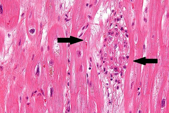 Gambaran mikroskopis jantung dengan pewarnaan hematoxylin eosin pada penderita penyakit jantung reumatik. Aschoff bodies