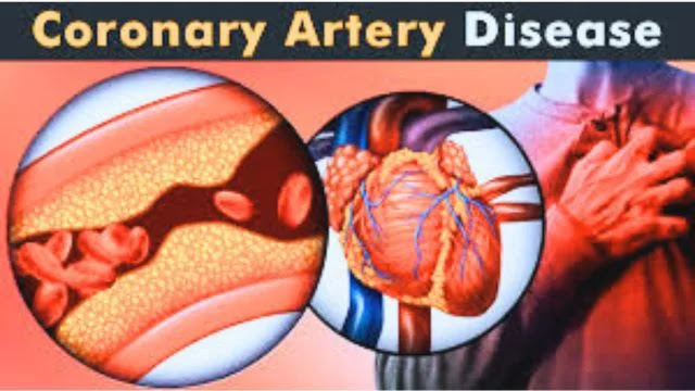 Coronary artery disease (CAD)-Key points about coronary artery disease