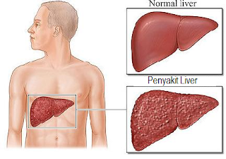 Cara Mengobati Penyakit Liver Menggunakan Obat Sakit Liver Alami