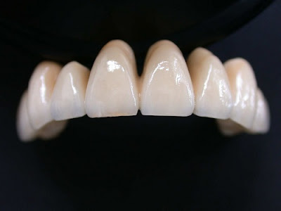 Răng sứ kim loại có tốt không? Răng nào tốt? 2