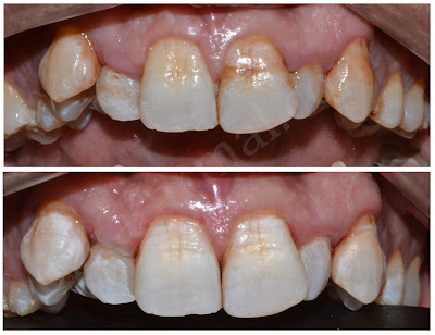 Dental Bleaching for Fluorosis of Teeth