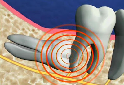 Tại sao phải điều trị răng nanh mọc ngầm trong xương hàm
