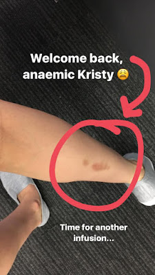 Welcome Back Anemic Kristy