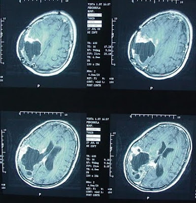 MRI of Brain Tumor picture 2