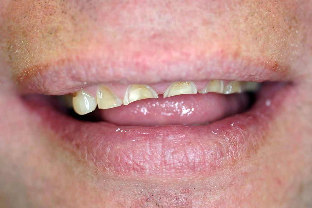Lesions Tongue