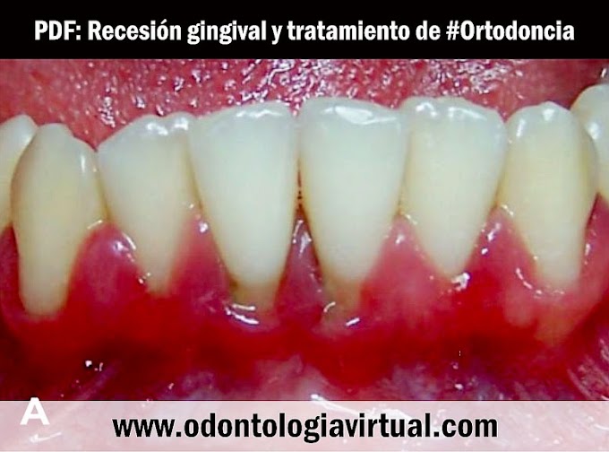 PDF: Recesión gingival y tratamiento de ortodoncia