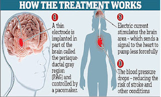 Doctors Lower Blood Pressure With Wire Inside the Brain