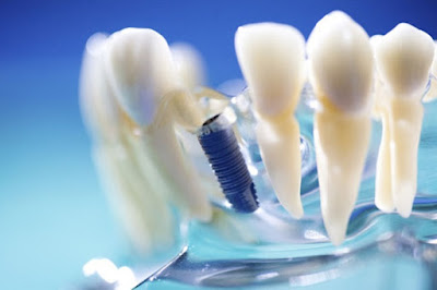 Cấy ghép răng implant là phương pháp gì