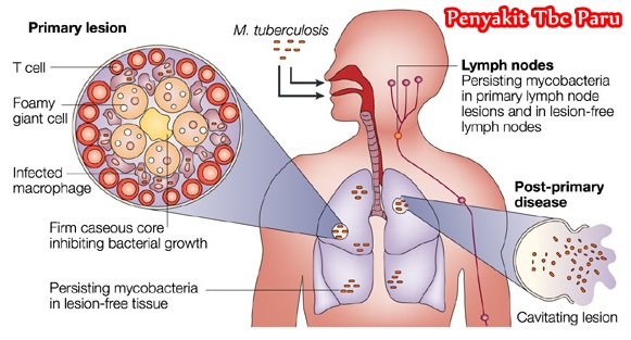 Cara Mudah Mengobati Tbc Paru Secara Alami Terbukti Manjur
