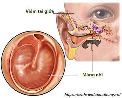 Hình ảnh viêm tai giữa ở trẻ sơ sinh-https://minhduy0705.blogspot.com/