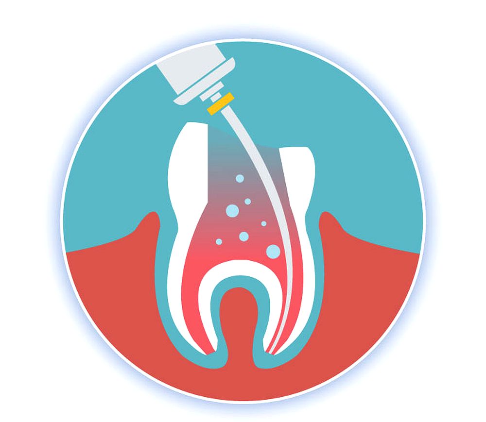 Endodoncia