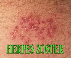 Nama Obat Medis Herpes Zoster 