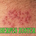 Nama Obat Medis Herpes Zoster