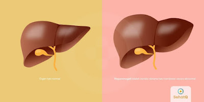 hepatomegali