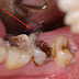 Bị sâu răng cấm có nhổ được không vậy nha sĩ?