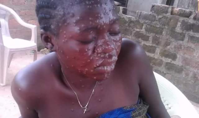 A suspected case of Monkey Pox recorded in Gboko, Benue State (photo)