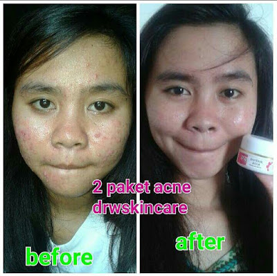 testimoni pengguna drw skincare