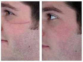 Scar Removal Before And After