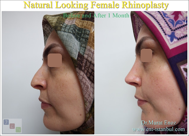 Natural rhinoplasty,Natural Nose Aesthetic Surgery,Natural Nose Job,Natural Looking Nose Operation,