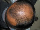 http://www.sldint.com/a/All_products/EVERGREEN_hair_regenerator/herbal-hair-loss-treatment.html