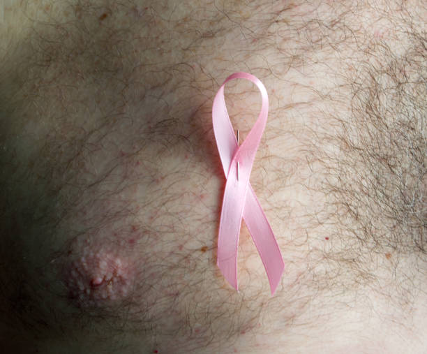 Symptoms of male breast cancer,  Male breast cancer treatment , Male breast cancer symptoms ,  Early stage signs of breast cancer in men