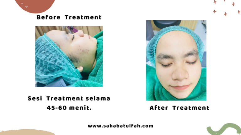 Treatment-Photo-Facial-Glow-ZAP-Padang