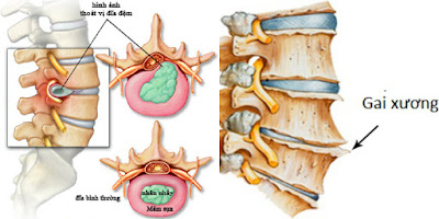 Cùng tìm hiểu về bệnh thoát vị đĩa đệm và bệnh gai cột sống