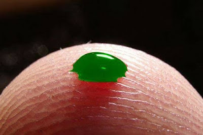 Sulfhemoglobinemia-a-condition-which-turns-blood-green