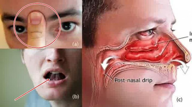  Menderita sekali rasanya ketika hidung tersumbat atau mampet 13 Cara Mengatasi Hidung Tersumbat/Mampet dengan Mudah