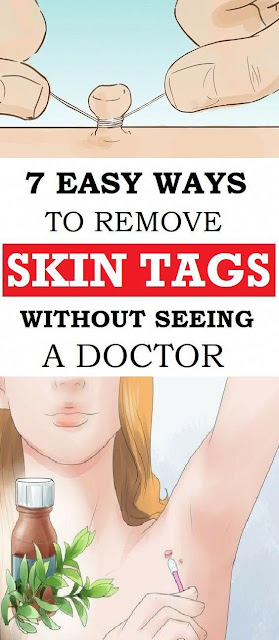 7 easy and homemade ways to remove skin tags without going to a doctor