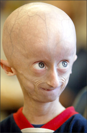 Progeria: Progeria Pictures