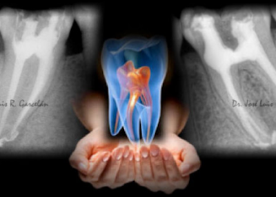 Pero, ¿cómo saber si os han hecho una endodoncia correctamente?